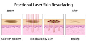 laser co2 frazionato cicatrici da acne