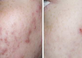 trattamenti laser dermatologici trattamento acne prima e dopo