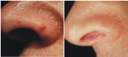 trattamenti laser dermatologici rimozione angioma prima e dopo