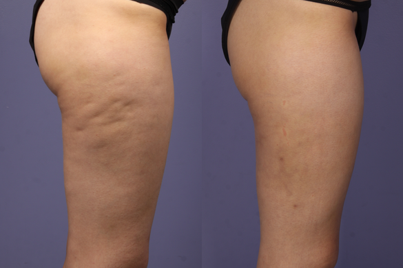 carbossiterapia riduzione cellulite e adiposità