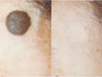 trattamenti laser dermatologici rimozione nei prima e dopo