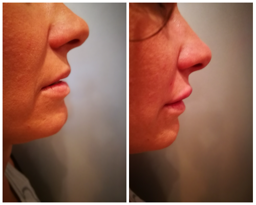 filler acido ialuronico labbra prima e dopo