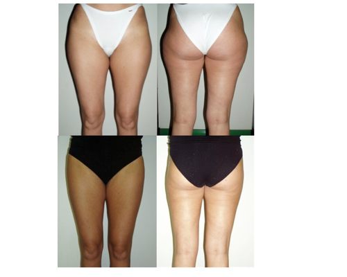 chirurgia plastica Liposuzione Glutei e Gambe risultati prima e dopo trattamento