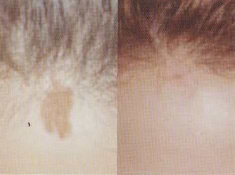 trattamenti laser dermatologici rimozione nei prima e dopo