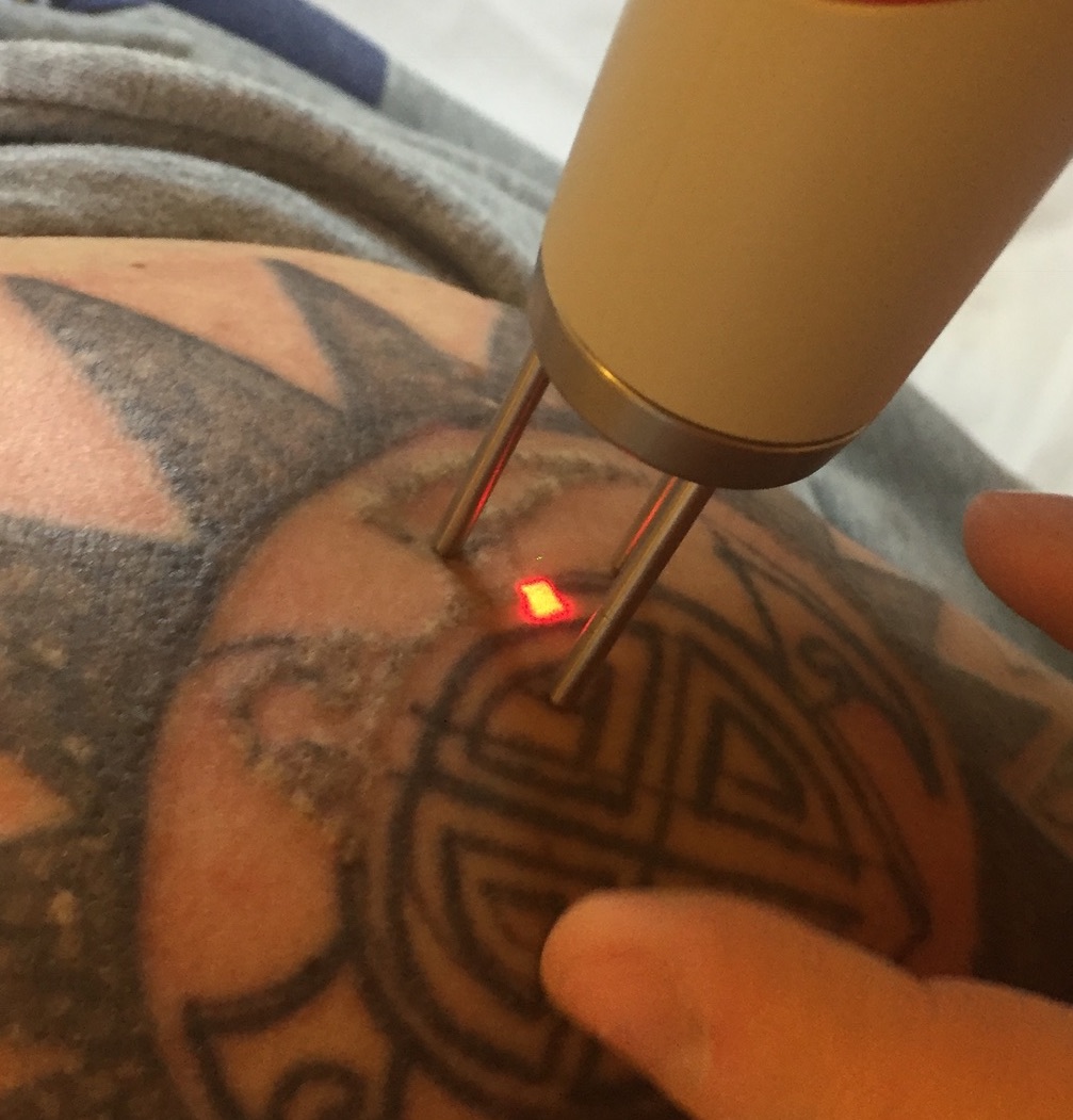 medicina estetica centro laser rimozione tatuaggi