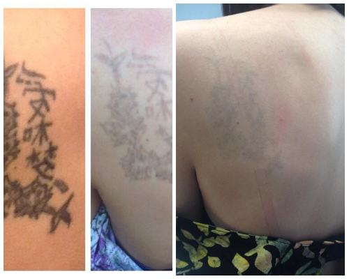 rimozione tatuaggi elaborato schiena prima e dopo 3 sedute