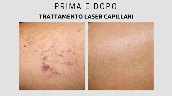 capillari viso e gambe risultati prima e dopo laser