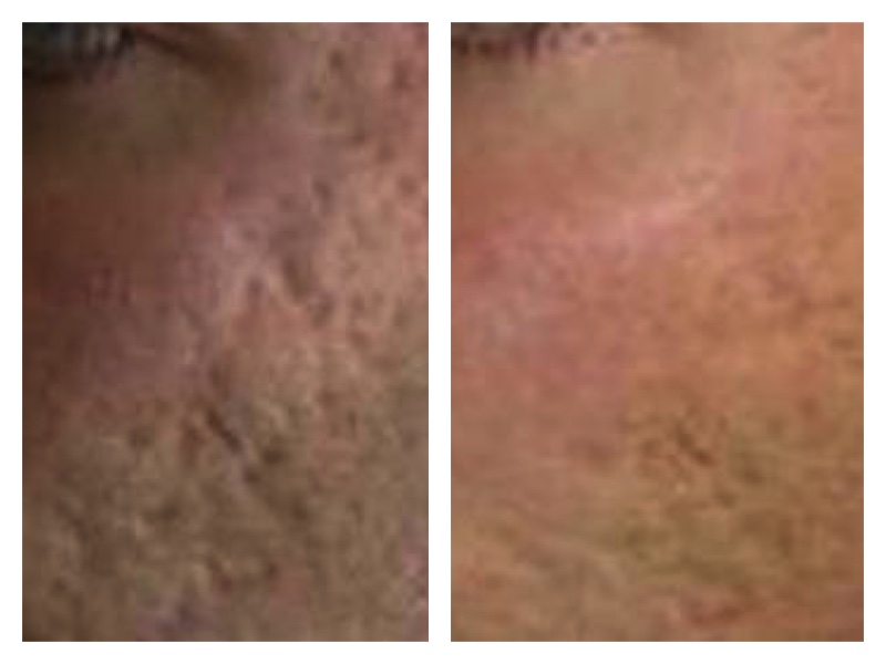 centro laser trattamento laser cicatrici acne