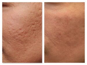 cicatrici da acne prima e dopo trattamento laser
