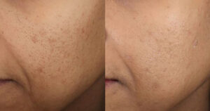 trattamento cicatrici acne con picolaser prma e dopo