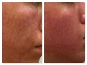 trattamento laser cicatrici da acne dopo una seduta