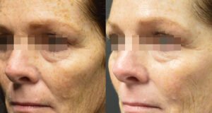 Pico Genesis efficacia trattamento viso