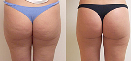 Velashape efficacia trattamento glutei