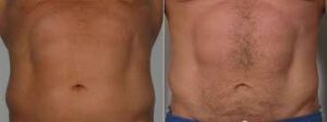 Velashape efficacia trattamento addome