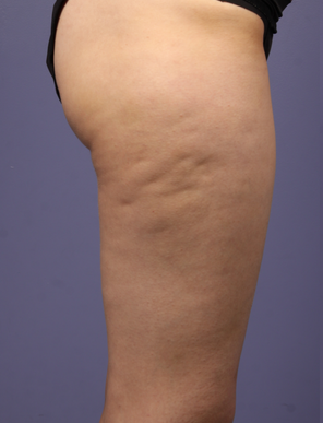 Eliminare la Cellulite quali trattamenti