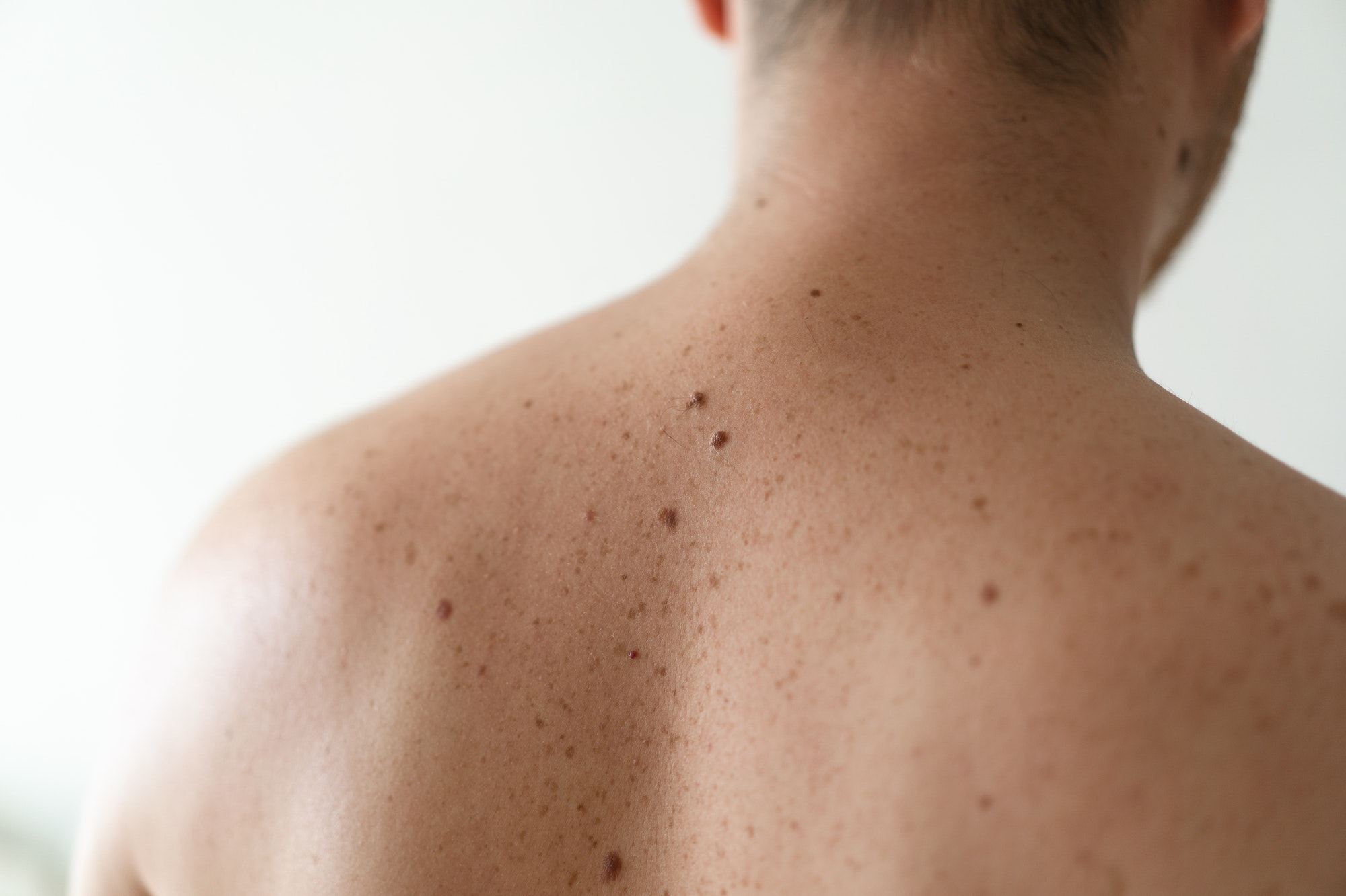 Close up detail of the bare skin on a man back with scattered moles and freckles.