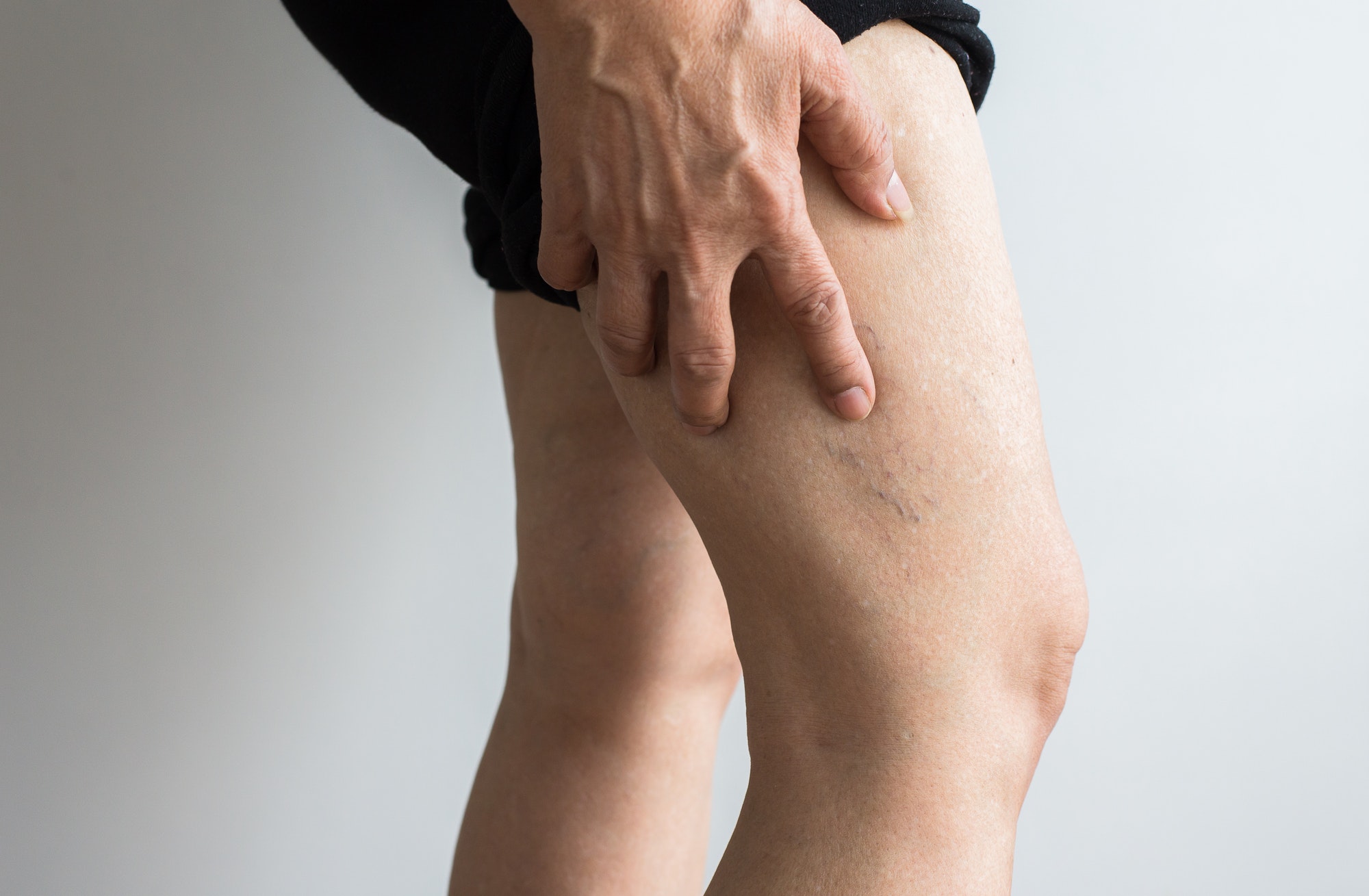 Varicose veins on the elderly woman legs,Close up