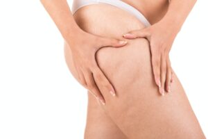 Cellulite e adiposità localizzata