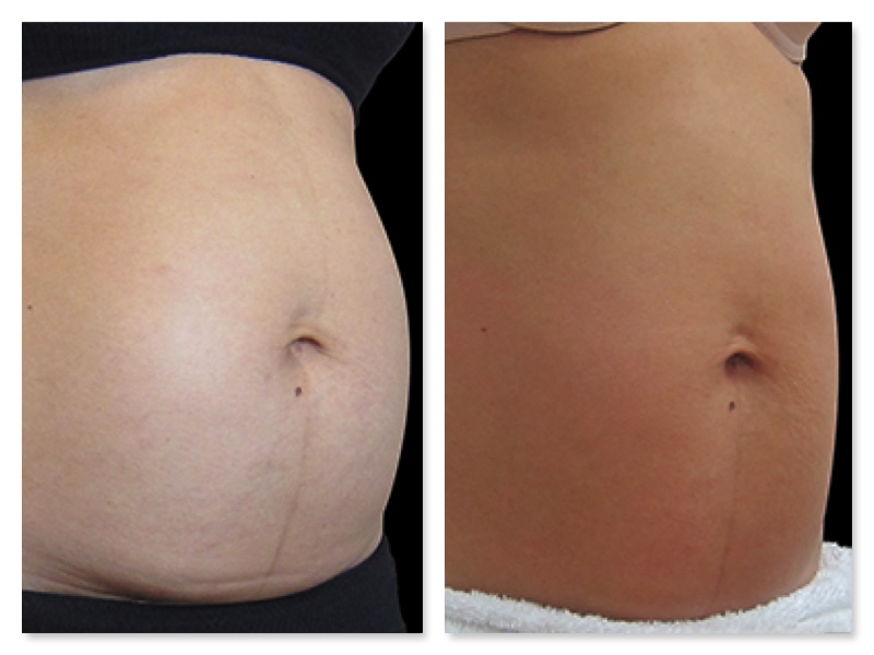 Efficacia addome trattamento BTL Exilis radiofrequenza