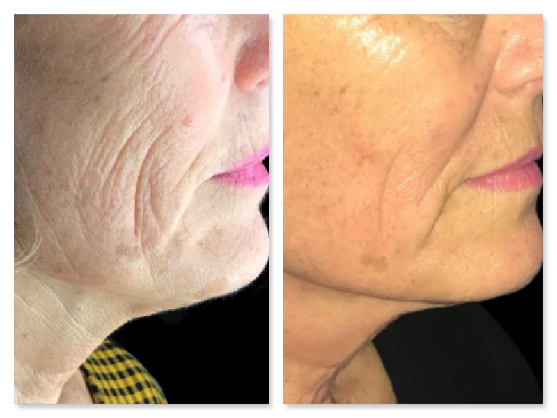 Efficacia viso trattamento BTL Exilis radiofrequenza